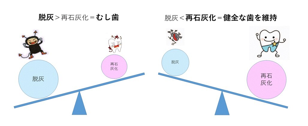 脱灰が再石灰化を上回るとむし歯になりますが、逆に再石灰化が脱灰を上回ると健全な歯を維持できます