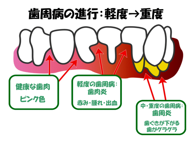 ピンク色の歯茎は健康、赤み・腫れ・出血があるのは軽度の歯周病、歯ぐきが下がったり歯がぐらぐらするのは中重度の歯周病のサイン